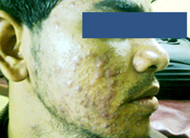 Platelet Rich Plasma Treatment Clinic in Dadar