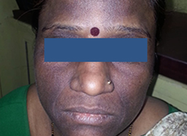 Platelet Rich Plasma Treatment Clinic in Dadar